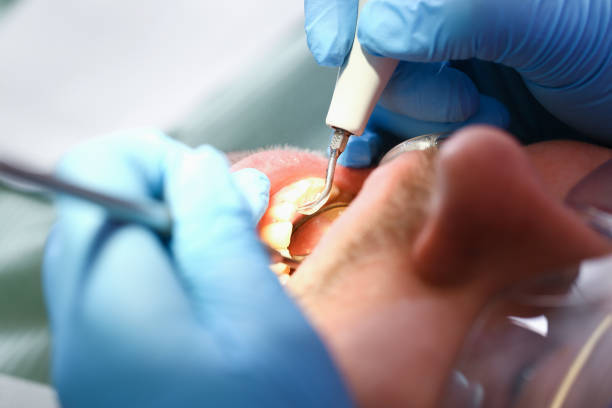 Best Emergency Dentist for Lost Fillings or Crowns in Bonnie Brae, IL